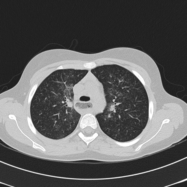 Achalasia (Radiopaedia 14946-14878 Axial lung window 21).jpg
