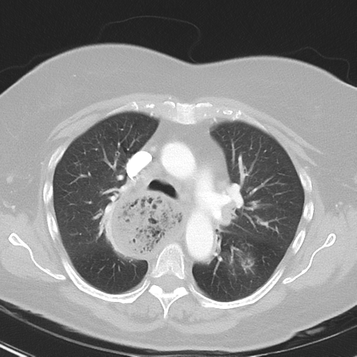 File:Achalasia (Radiopaedia 47147-51685 Axial lung window 19).png