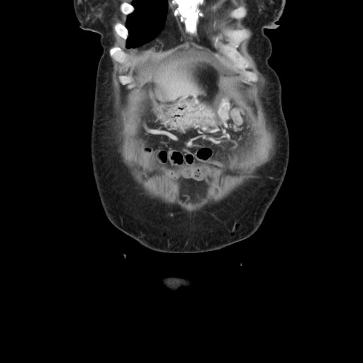 Acinar cell carcinoma of the pancreas (Radiopaedia 75442-86669 Coronal C+ portal venous phase 18).jpg