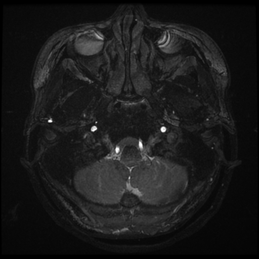 Acoustic neuroma (Radiopaedia 34049-35283 Axial 5).png