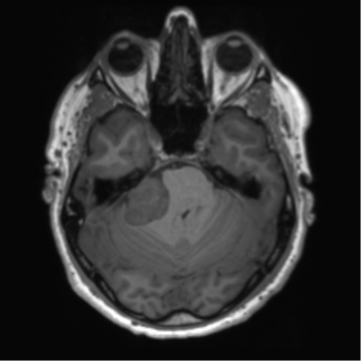 File:Acoustic schwannoma (Radiopaedia 50846-56358 Axial T1 29).png