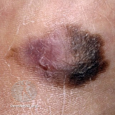 File:Acral lentignous melanoma (DermNet NZ lesions-melanoma-s-alm9).jpg