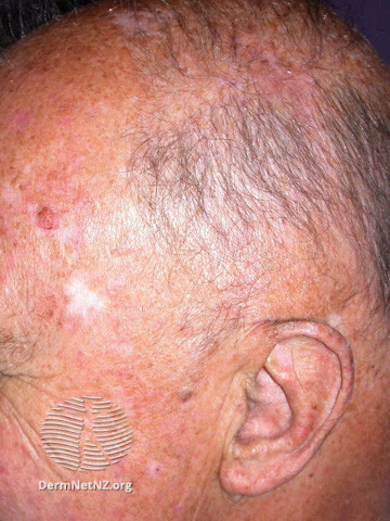 File:Actinic Keratoses treated with imiquimod (DermNet NZ lesions-ak-imiquimod-3766).jpg