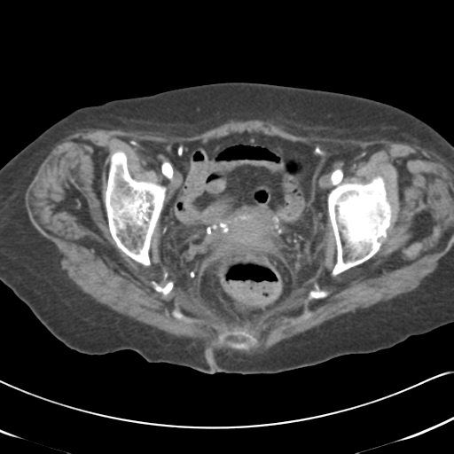 Active bleeding from duodenal ulcer with embolization (Radiopaedia 34216-35481 Axial C+ arterial phase 60).png