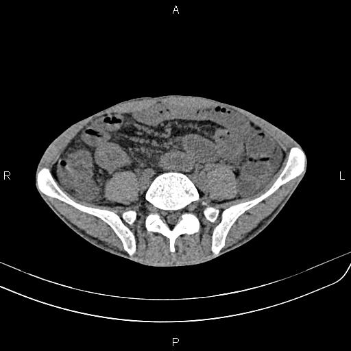 Active crohn disease (Radiopaedia 87133-103397 Axial non-contrast 69).jpg