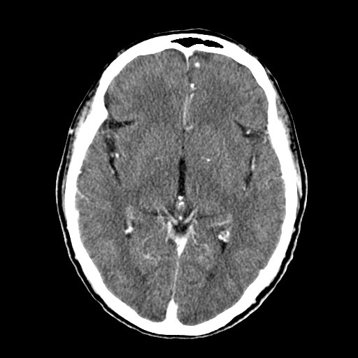 File:Active neurocysticercosis before and after therapy (Radiopaedia 71710-82100 Axial C+ delayed 41).jpg