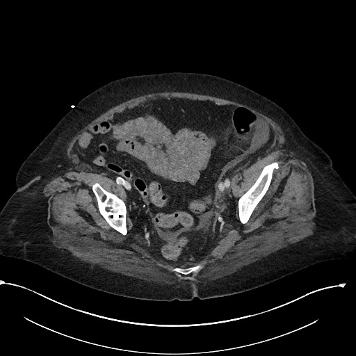 File:Active renal extravasation with large subcapsular and retroperitoneal hemorrhage (Radiopaedia 60975-68796 Axial 294).jpg