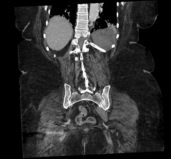 File:Active renal extravasation with large subcapsular and retroperitoneal hemorrhage (Radiopaedia 60975-68796 Coronal C+ portal venous phase 120).jpg