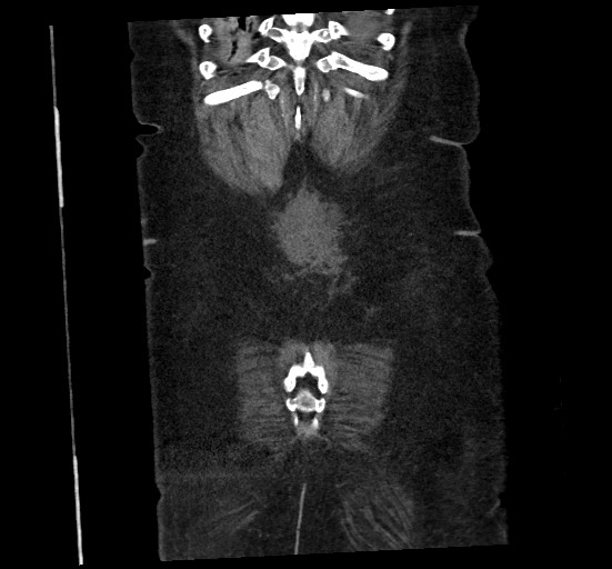 Active renal extravasation with large subcapsular and retroperitoneal hemorrhage (Radiopaedia 60975-68796 Coronal C+ portal venous phase 138).jpg