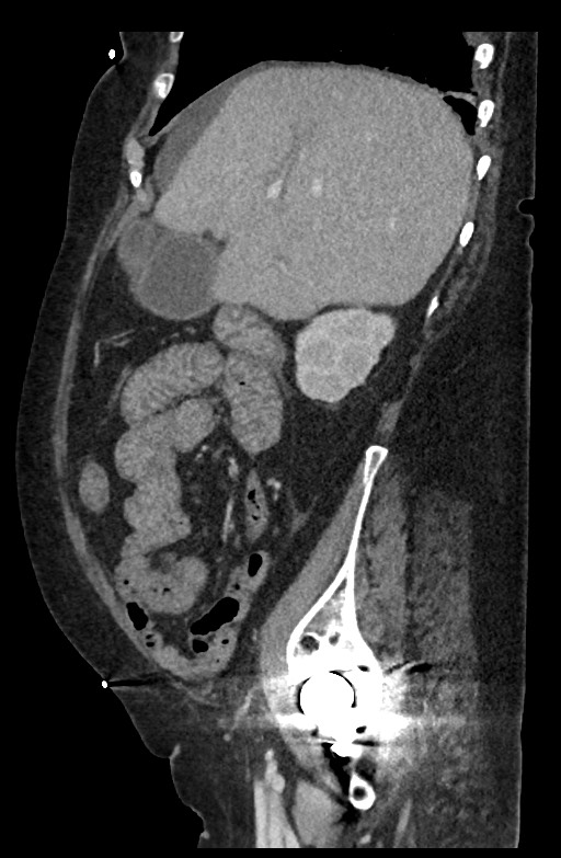 Active renal extravasation with large subcapsular and retroperitoneal hemorrhage (Radiopaedia 60975-68796 Sagittal C+ portal venous phase 160).jpg