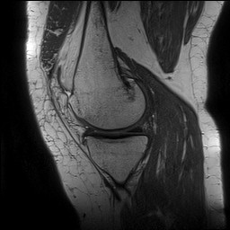Acute-on-chronic transient lateral patellar dislocation with trochlear dysplasia (Radiopaedia 84099-99349 Sagittal PD 59).jpg