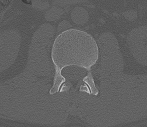 File:Acute L1 burst compression fracture (Radiopaedia 34430-35755 Axial bone window 31).png