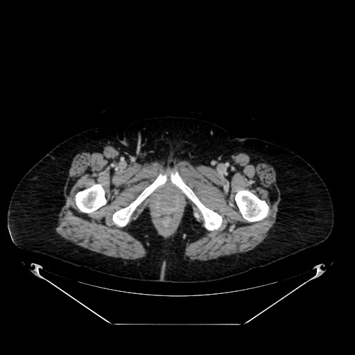 File:Acute appendicitis, heterotaxy syndrome (Radiopaedia 66884-76202 Axial C+ portal venous phase 136).jpg
