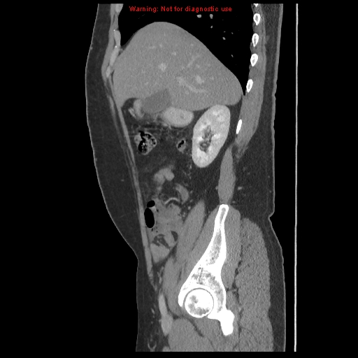 File:Acute appendicitis (Radiopaedia 10498-10973 Sagittal C+ portal venous phase 3).jpg