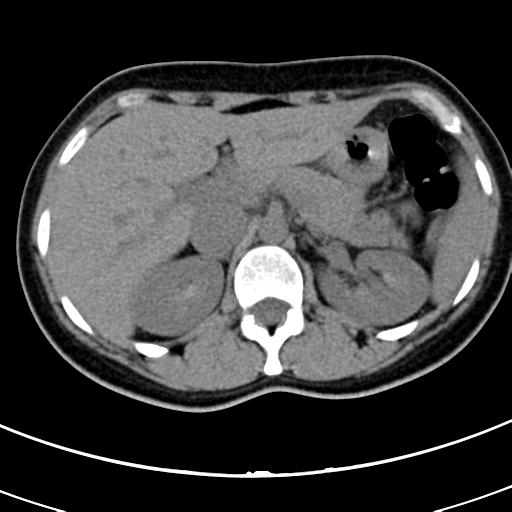 Acute appendicitis (Radiopaedia 30261-30888 Axial non-contrast 13).jpg