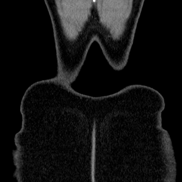 Acute appendicitis (Radiopaedia 38255-40270 Coronal C+ portal venous phase 89).jpg