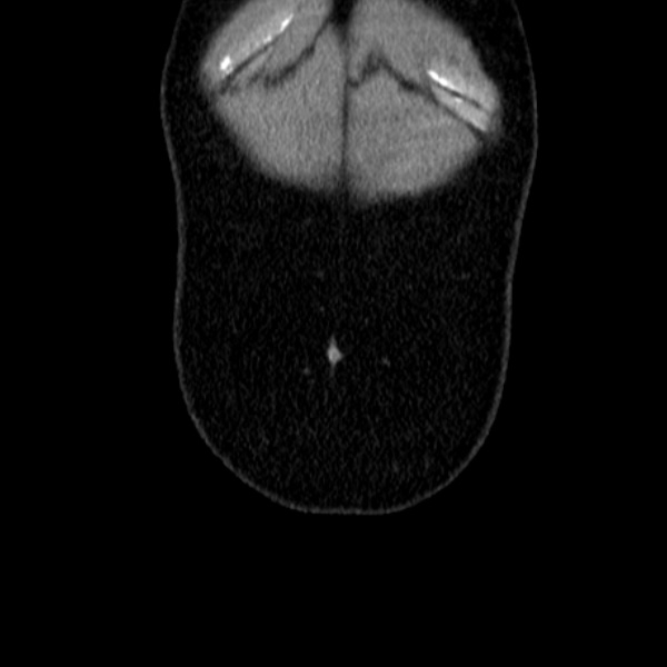 Acute appendicitis (Radiopaedia 38255-40270 Coronal C+ portal venous phase 9).jpg