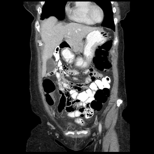 Acute appendicitis (Radiopaedia 52672-58589 Coronal C+ portal venous phase 14).jpg