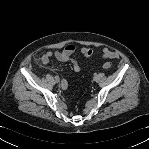 Acute appendicitis (Radiopaedia 58627-65818 Axial non-contrast 70).jpg