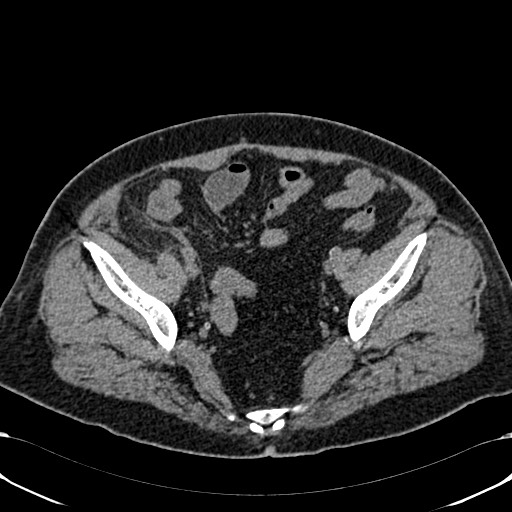 Acute appendicitis (Radiopaedia 58627-65818 Axial non-contrast 72).jpg