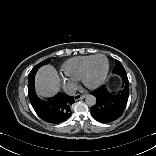 Acute appendicitis (Radiopaedia 58627-65818 Axial non-contrast 8).jpg