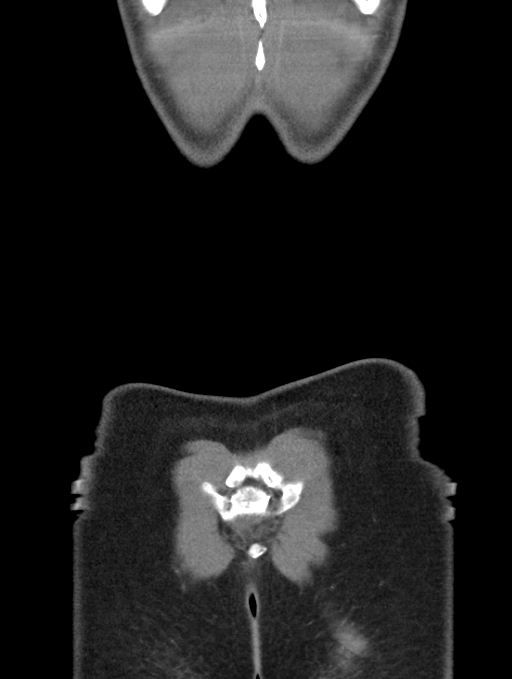Acute appendicitis (Radiopaedia 62608-70901 Coronal C+ portal venous phase 64).jpg