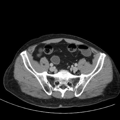 Acute appendicitis (Radiopaedia 66513-75790 Axial C+ portal venous phase 69).jpg