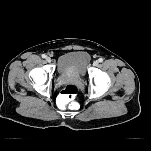 Acute appendicitis (Radiopaedia 77016-88960 Axial C+ portal venous phase 133).jpg