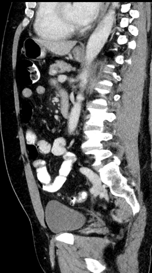 Acute appendicitis (Radiopaedia 77016-88960 Sagittal C+ portal venous phase 49).jpg