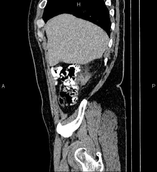 File:Acute appendicitis (Radiopaedia 84780-100240 Sagittal C+ portal venous phase 14).jpg