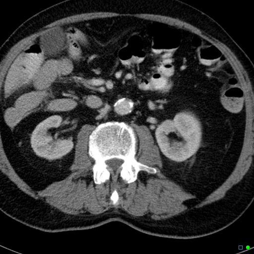 File:Acute appendicitis arising from a malrotated cecum (Radiopaedia 19970-19997 Axial C+ portal venous phase 11).jpg