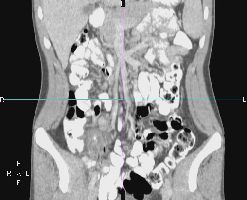 File:Acute appendicitis with CT arrowhead sign (Radiopaedia 21474-21411 Coronal C+ portal venous phase 7).JPG