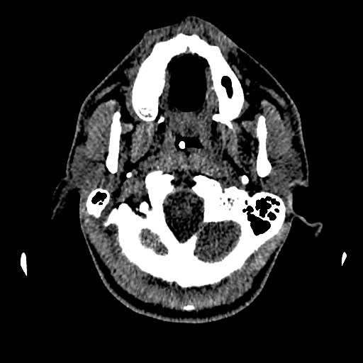 Acute basilar artery occlusion (Radiopaedia 43582-46985 Axial non-contrast 28).jpg