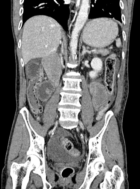 Acute bowel ischemia (Radiopaedia 87695-104114 Coronal C+ portal venous phase 236).jpg