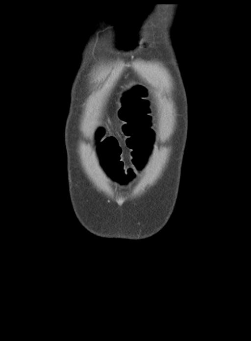 Acute cholecystitis (Radiopaedia 29814-30327 Coronal C+ portal venous phase 5).jpg