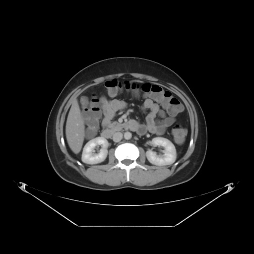 File:Acute complicated calculous cholecystitis (Radiopaedia 55202-61587 Axial C+ delayed 45).jpg