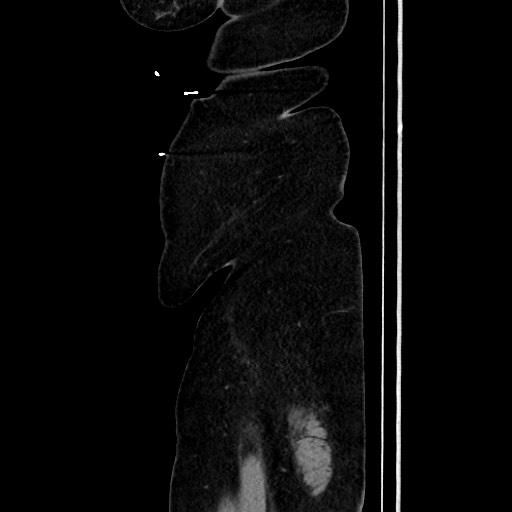 Acute diverticulitis - transverse colon (Radiopaedia 87063-103327 Sagittal C+ portal venous phase 210).jpg