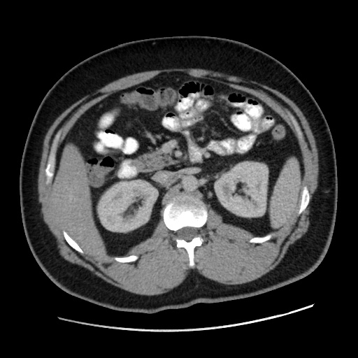 Acute diverticulitis with localized perforation (Radiopaedia 41296-44113 Axial C+ portal venous phase 35).jpg