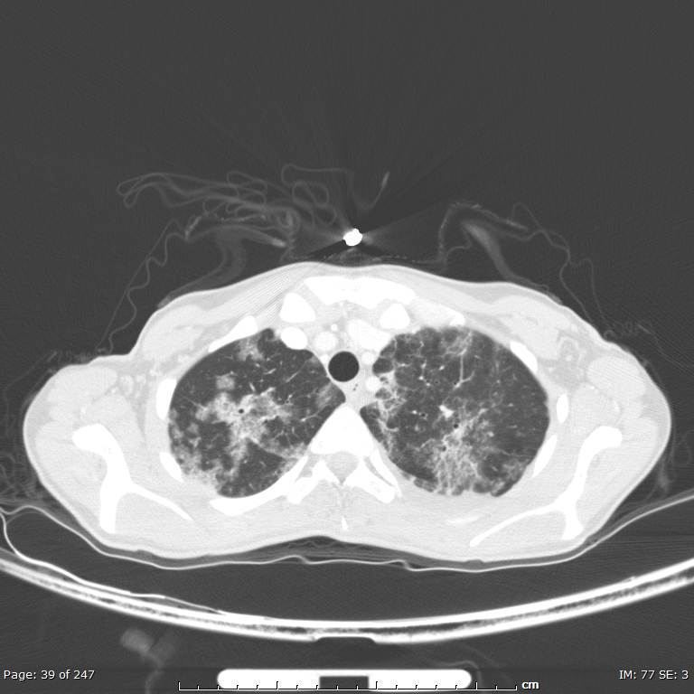 Acute eosinophilic pneumonia (Radiopaedia 48211-53073 Axial lung window 14).jpg