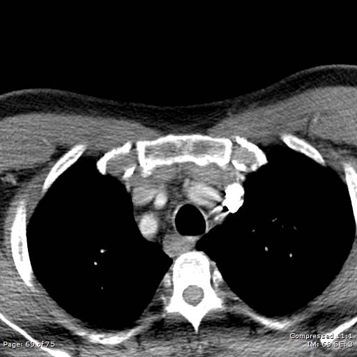 Acute epiglottitis (Radiopaedia 54375-60590 Axial C+ arterial phase 69).jpg