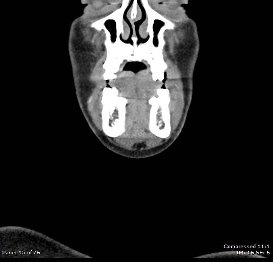 Acute epiglottitis (Radiopaedia 54375-60590 Coronal C+ arterial phase 15).jpg