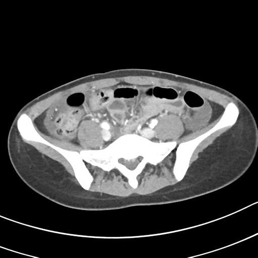 Acute gangrenous appendicitis with perforation (Radiopaedia 40152-42662 Axial C+ portal venous phase 50).png