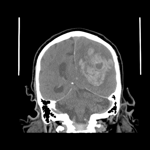 Acute hemorrhagic stroke (Radiopaedia 17507-17223 Coronal non-contrast 35).jpg