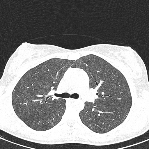 File:Acute hypersensitivity pneumonitis (Radiopaedia 85293-100870 Axial lung window 43).jpg