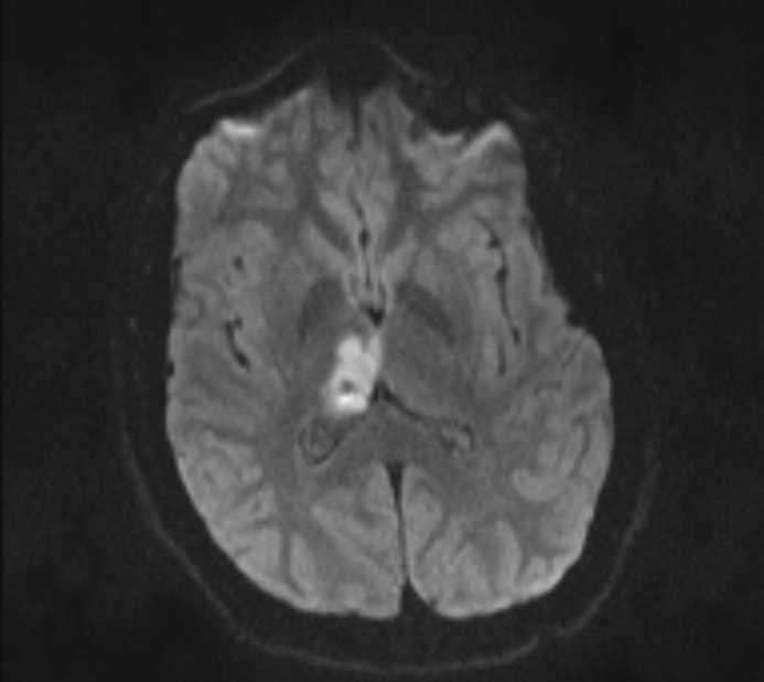 Acute ischemic stroke - posterior circulation territory (Radiopaedia 77670-89880 Axial DWI 36).jpg