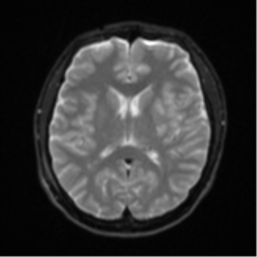 Acute left middle cerebral artery territory infarct with clot retrieval (Radiopaedia 47732-52433 Axial DWI 17).png