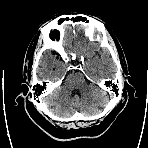 Acute left middle cerebral artery territory ischemic stroke (Radiopaedia 35688-37223 Axial non-contrast 21).png