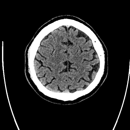 Acute left middle cerebral artery territory ischemic stroke (Radiopaedia 35688-37223 Axial non-contrast 67).png