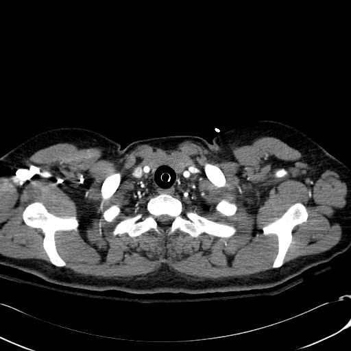 File:Acute myocardial infarction in CT (Radiopaedia 39947-42415 Axial C+ arterial phase 8).jpg