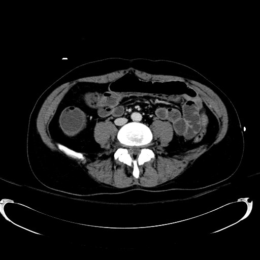Acute myocardial infarction in CT (Radiopaedia 39947-42415 Axial C+ portal venous phase 79).jpg